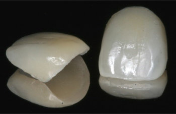 veneers_2